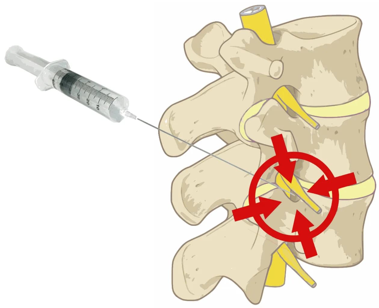 Jak leczyć zaburzenia korzeni rdzeniowych? Kompletny przewodnik