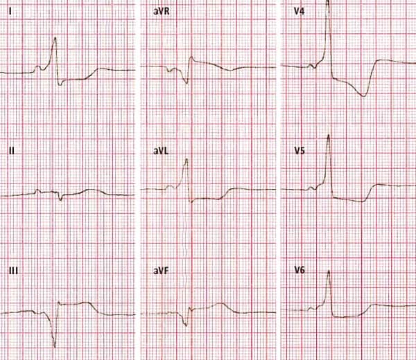 Objawy zaburzeń repolaryzacji EKG: Kiedy się martwić, a kiedy nie?