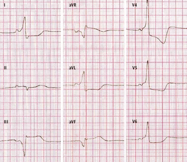 Objawy zaburzeń repolaryzacji EKG: Kiedy się martwić, a kiedy nie?